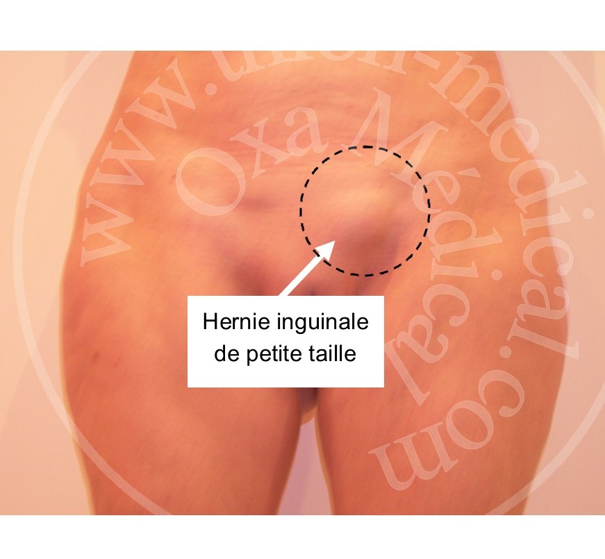 Hernie inguinale de petite taille